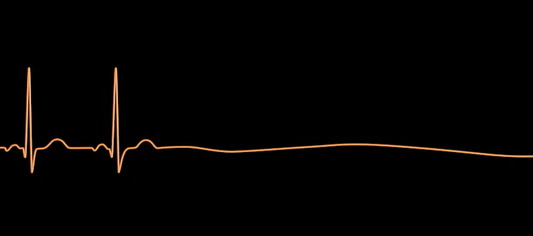 Aystole heart rhythm showing no electrical activity