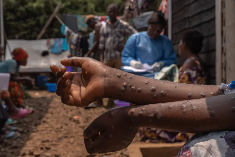 Les bras d’une personne contaminée par le mpox sont recouverts de boutons