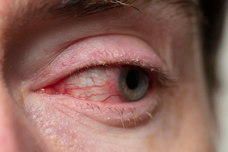 Close up of an eye with conjunctivitis.