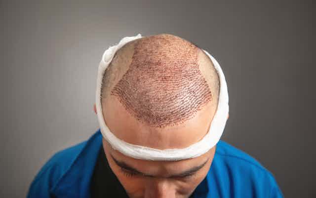 As hair transplants become big business, here's what you need to know about  the risks