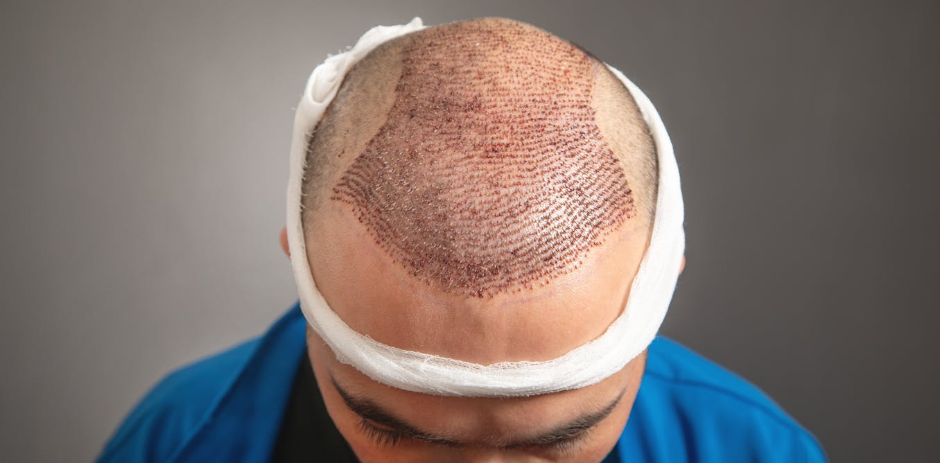 As hair transplants become big business, here's what you need to know about  the risks