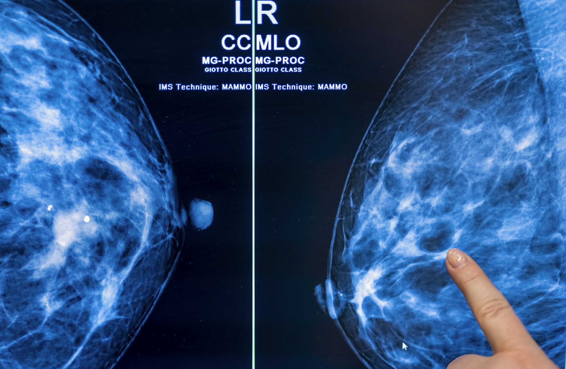 FDA’s New Regulations Underscore the Complexity Around Screening for Women with Dense Breasts