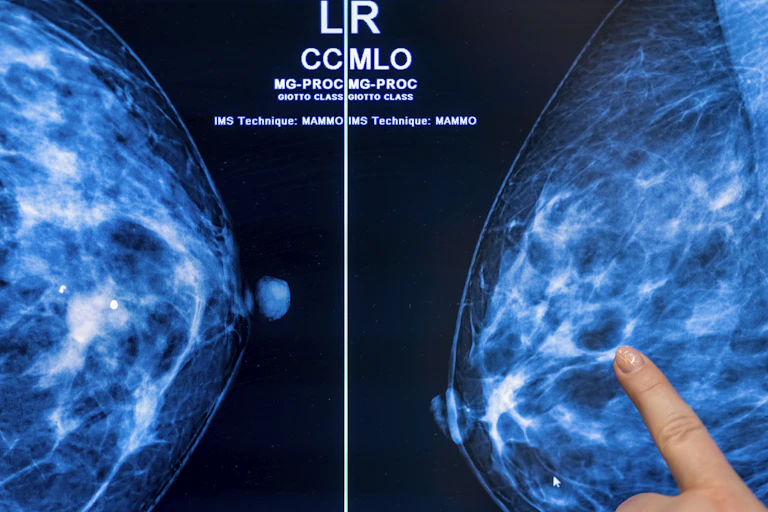 Medical personnel examine mammogram images to screen for breast cancer.