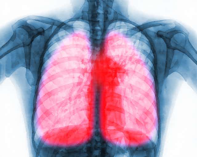 X-ray of person's torso with lungs highlighted in red