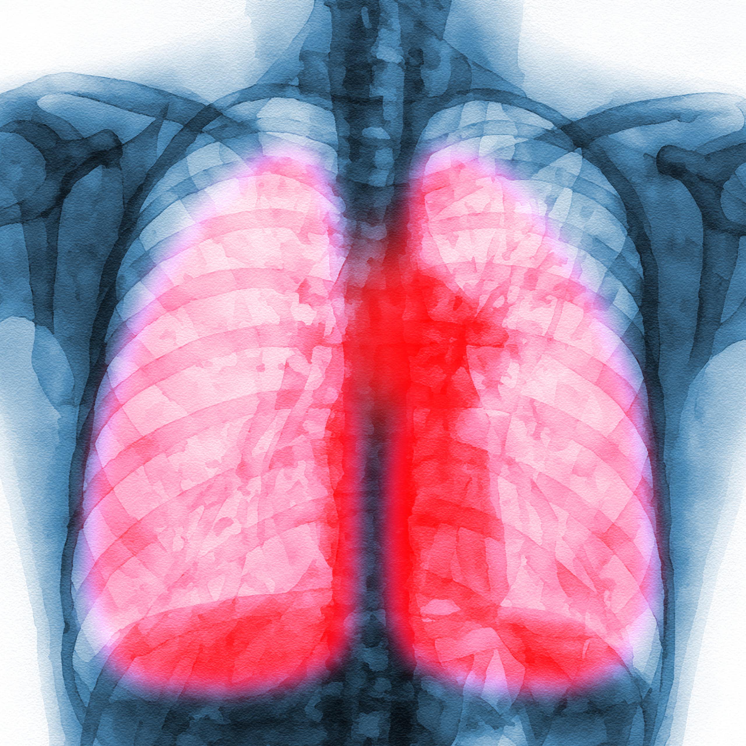 X-ray of person's torso with lungs highlighted in red