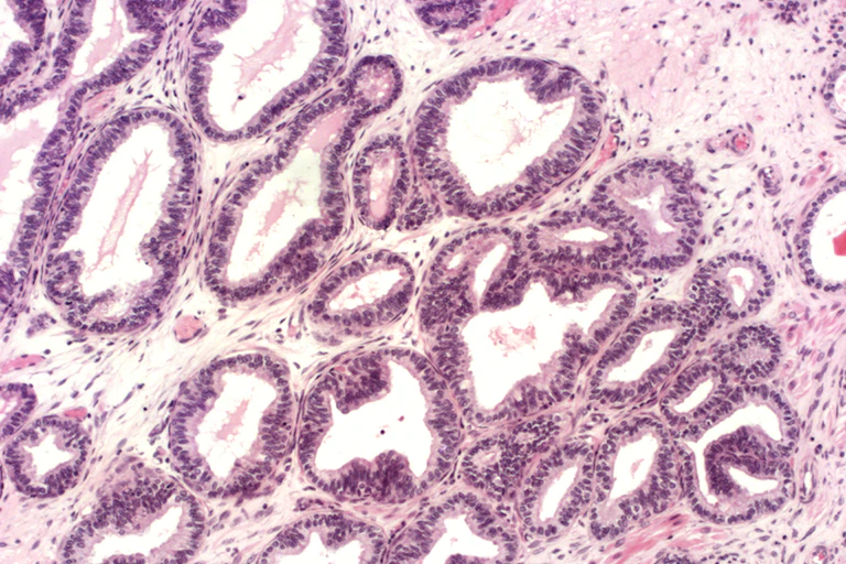 A close up of pink prostate cells.