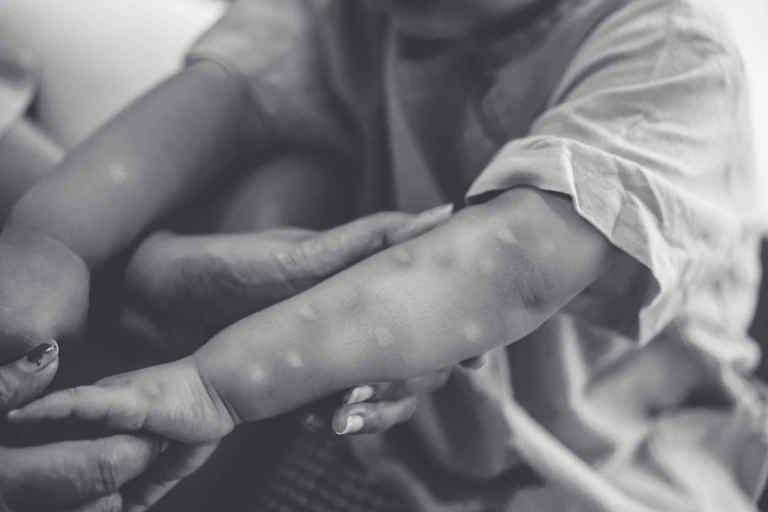 Black and white image of a small child with mpox lesions on their forearms