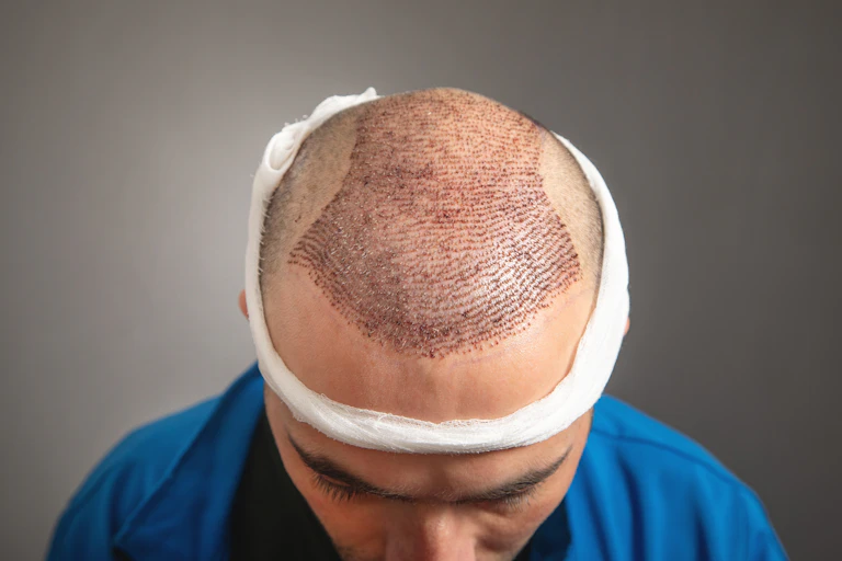 Um homem mostra seu couro cabeludo para a câmera, que tem muitos furos e crostas de um procedimento de transplante de cabelo