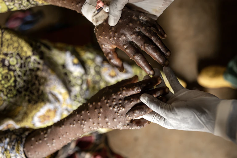Mpox patient, with affected hands and arms, receives treatment