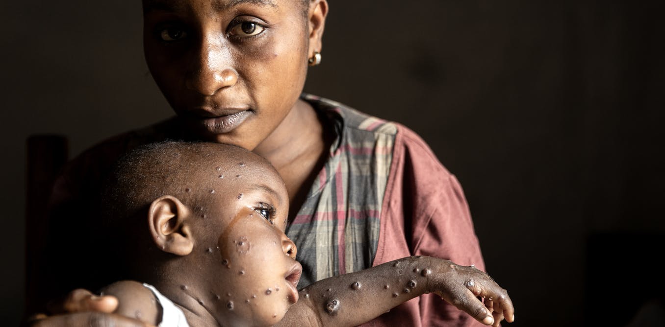 Why mpox in africa was ignored for too long and children are dying as a result – podcast