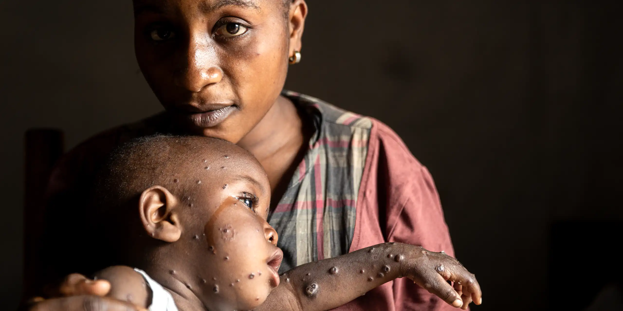 A woman holds her son who has mpox.
