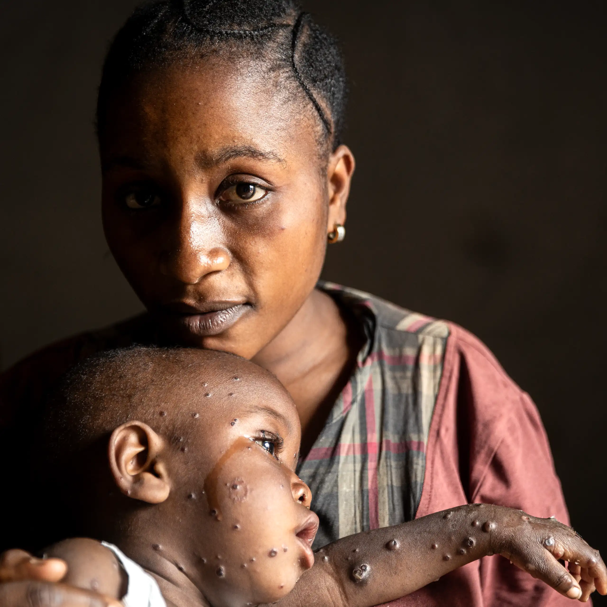 A woman holds her son who has mpox.