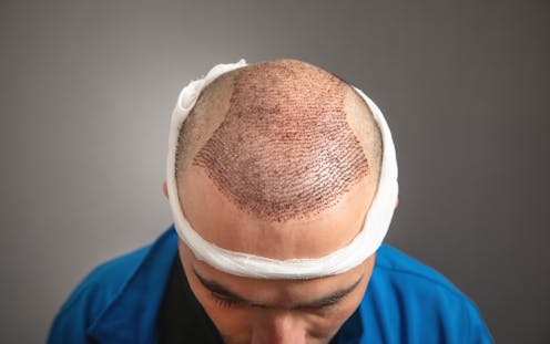 Transplantasi rambut makin marak, ketahui risikonya lebih dahulu