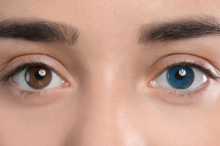 A person with heterochromia – one brown eye and one blue eye.