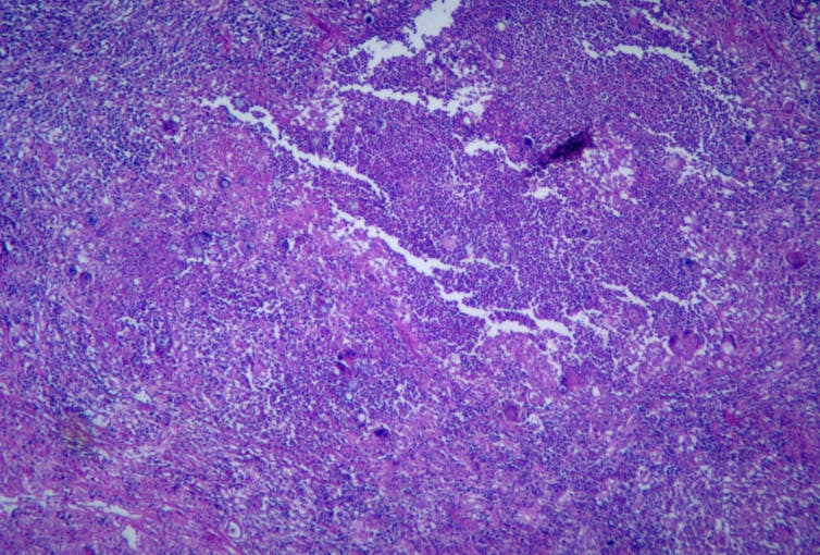 Purple-stained image showing spores of the coccidioidomycosis fungus.