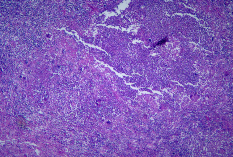 Purple-stained image showing spores of the coccidioidomycosis fungus.