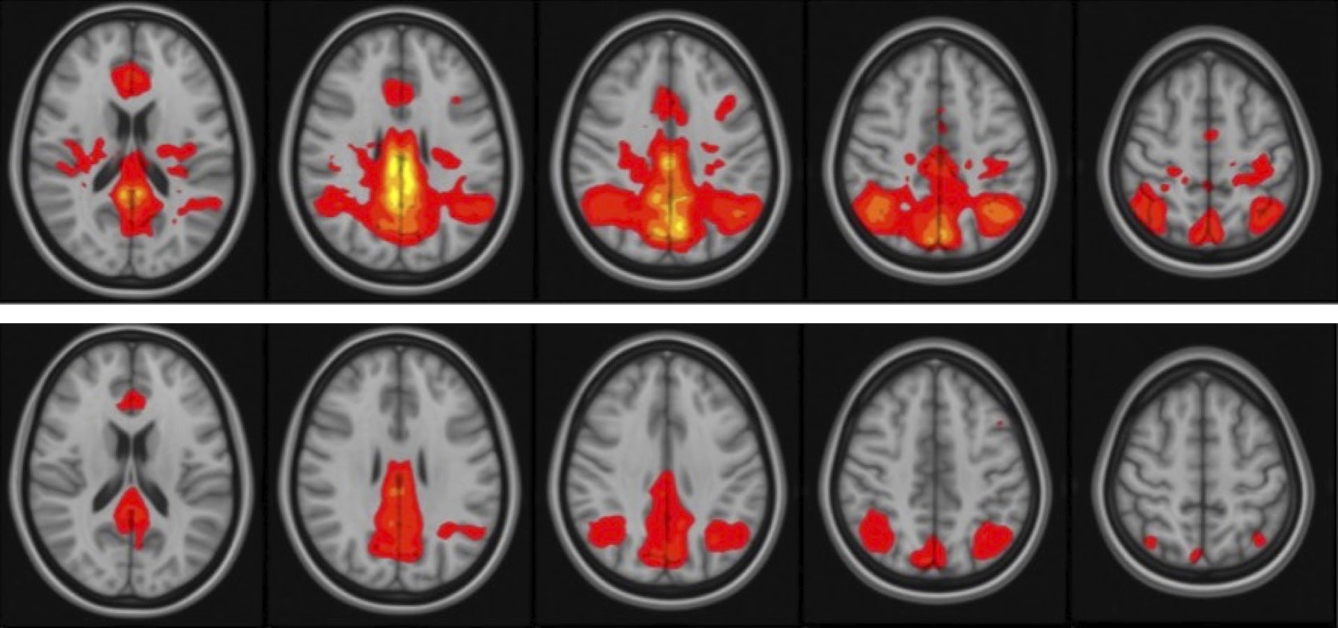 Resiliency and concussion Why do some athletes develop