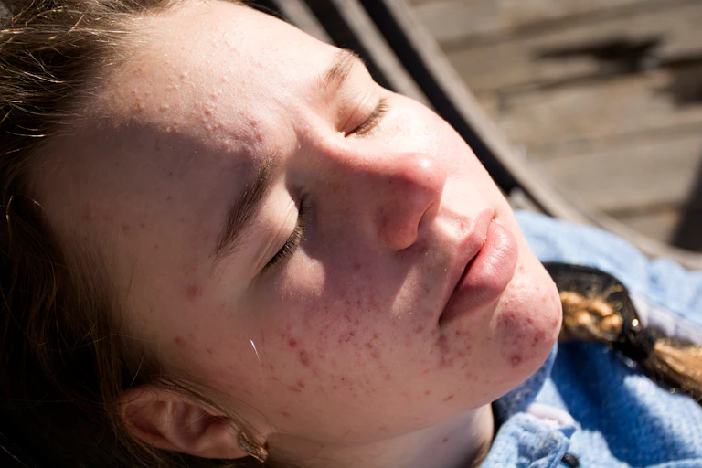 A young girl with acne sits with the sun on her face.