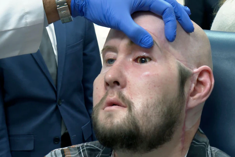 A surgeon examines Aaron James's transplanted eye.