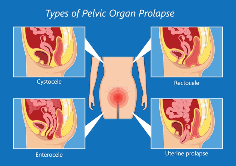 A diagram shows four different kinds of pelvic organ prolapse: cystocele, enterocele, rectocele and unterine prolapse.