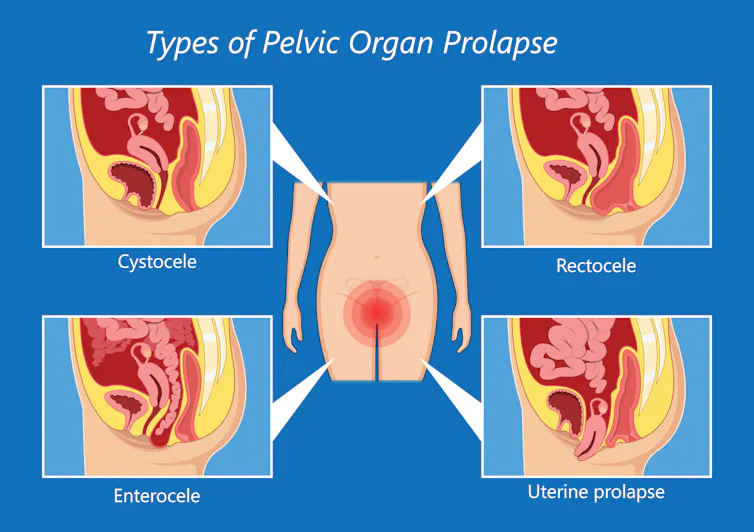 A diagram shows four different kinds of pelvic organ prolapse: cystocele, enterocele, rectocele and unterine prolapse.