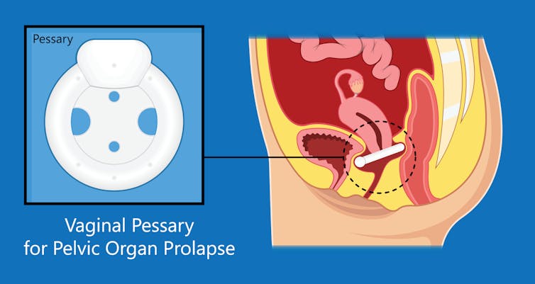 Diagram of a vaginal pessary close-up next to diagram of pessary inserted in cross-section of vagina.