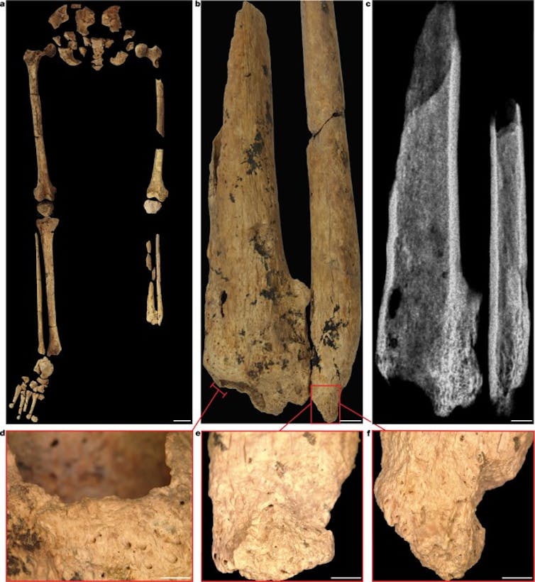 Evidencia de amputación de extremo distal de tibia y peroné izquierdo