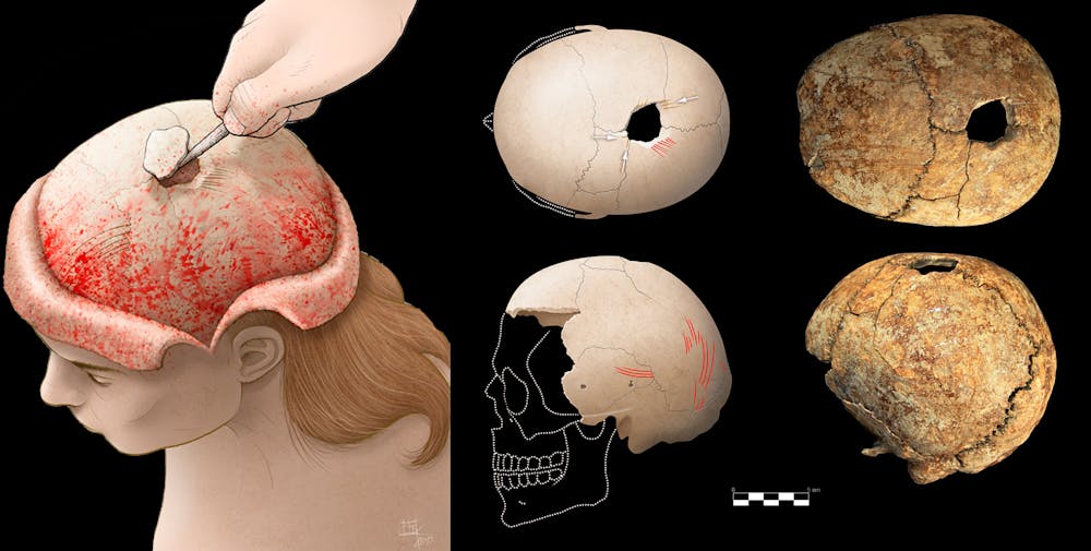 El éxito de la cirugía craneal en la prehistoria