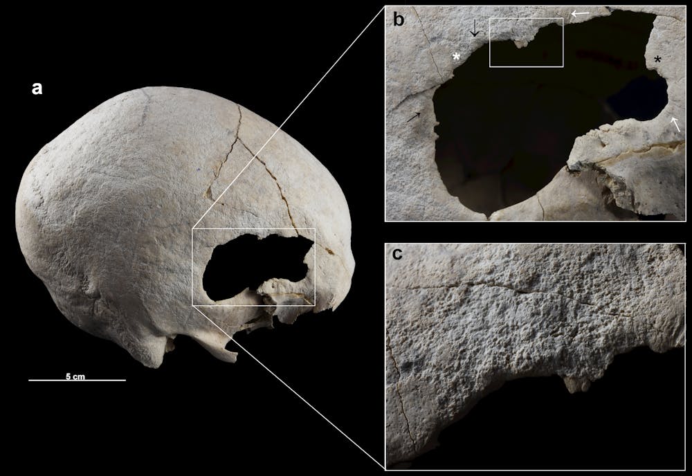 El éxito de la cirugía craneal en la prehistoria