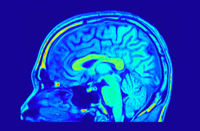 research article on the brain Human Brain MRI.