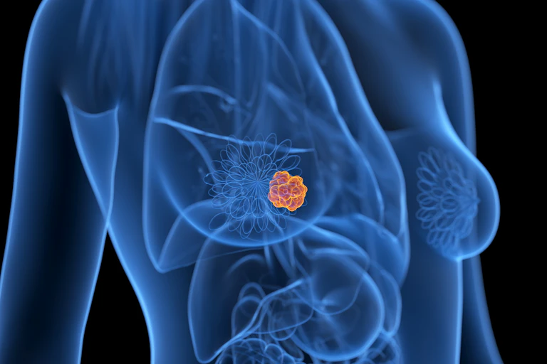 Graphic illustration of a growth in a breast