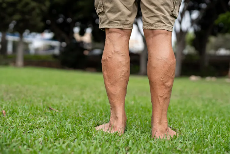 A man's lower legs covered in varicose veins.