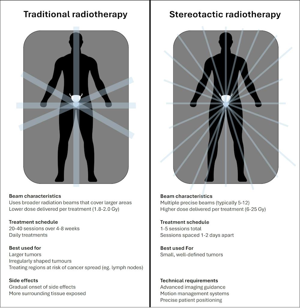 What Is Stereotactic Radiation Therapy For Prostate Cancer? How Does It ...