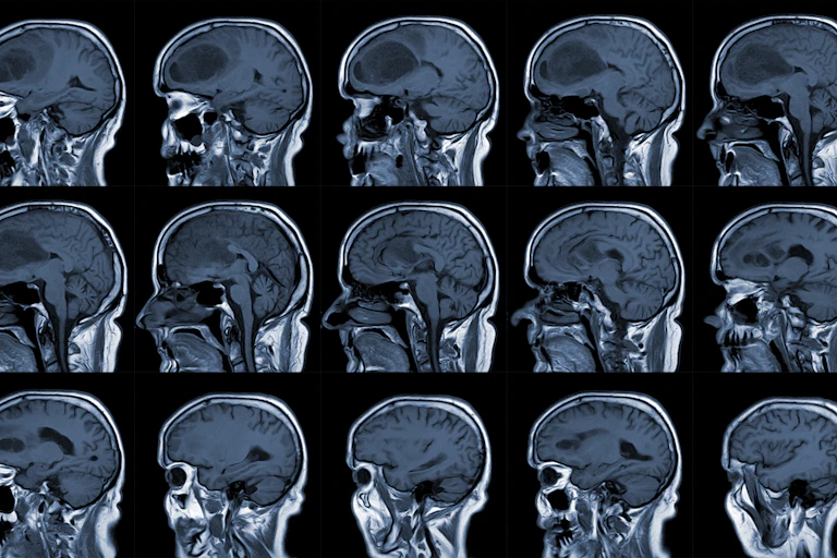 MRI of a brain with a glioblastoma.