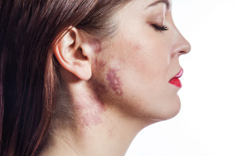 A woman with a port wine stain birthmark on her face and neck.