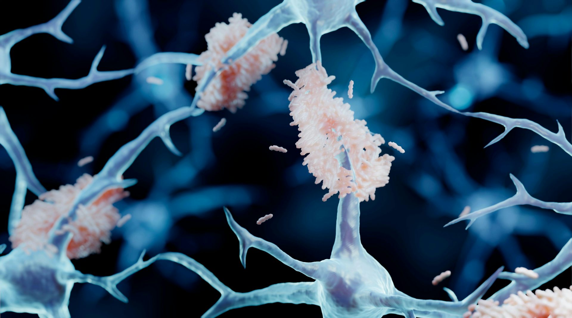 An illustration of amyloid plaques forming on neurons.