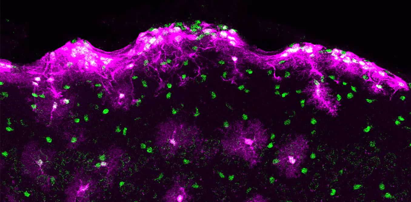 New research supports brain cell transplantation as a treatment for some neurological disorders New research supports brain cell transplantation as a treatment for some neurological disorders