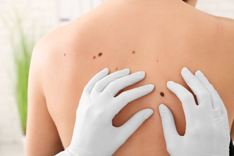 Health worker wearing gloves examining back of patient with moles