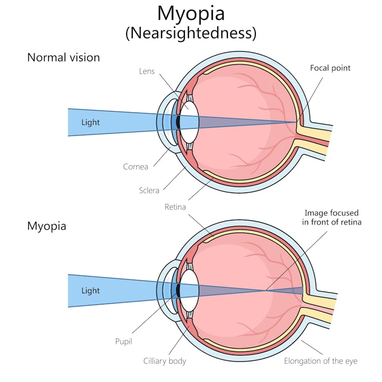 Diagram compares light refracting in a normal eyeball to a myopic eyeball, where the focal point is in front of the retina.