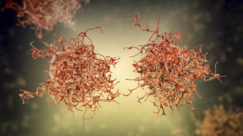 Cervical cancer news, research and analysis - the conversation