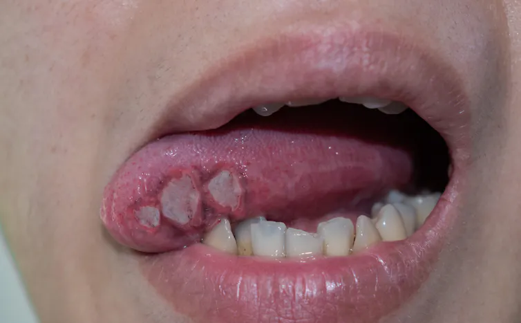 A person with large mouth ulcers on the underside of their tongue.