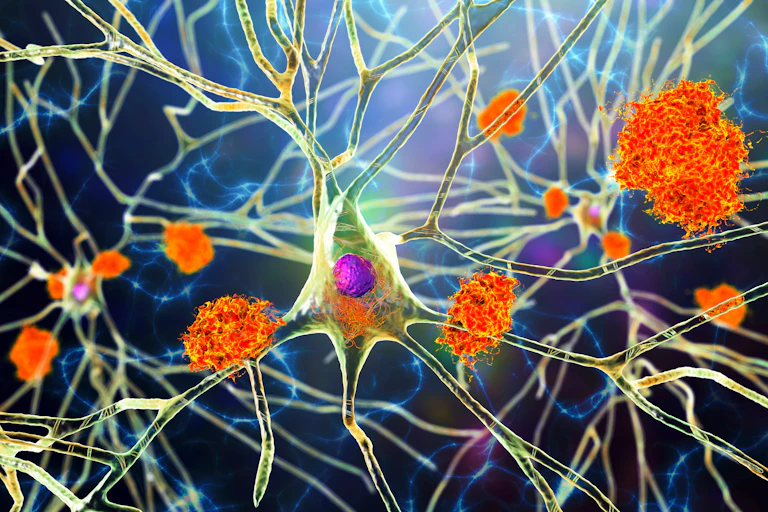 A digital drawing depicting amyloid plaques and neurofibrillary tangles between neurons.
