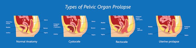 Illustration of several types of pelvic organ prolapse