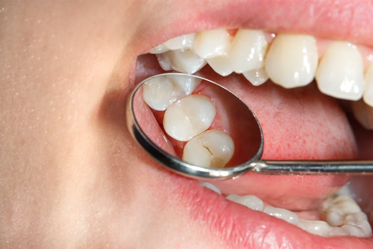 Close-up of a dental mirror in someone's mouth looking at tooth decay.