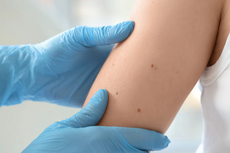 hands in blue gloves examine freckles on arm