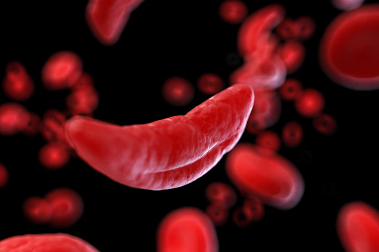 3d rendered medical illustration of a sickle cell