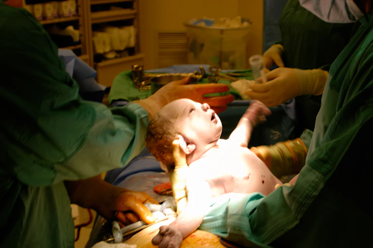 A baby being delivered by caesarean section.