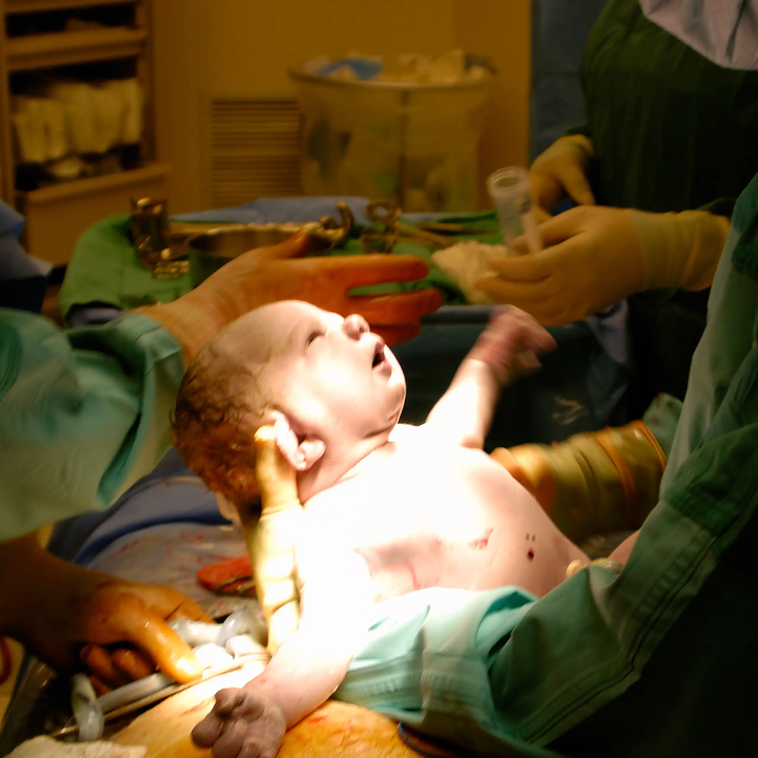 A baby being delivered by caesarean section.
