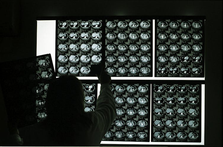 Clinician hanging up several MRI result sheets against a lightbox