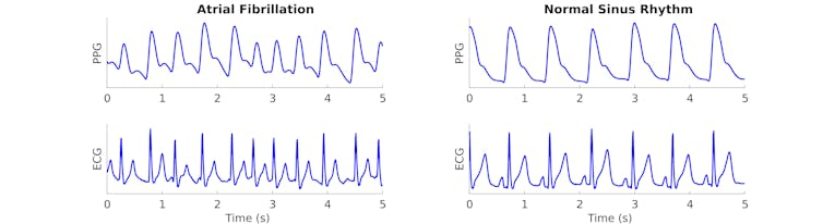 Diagram of atrial fibrillation vrs normal sinus rhythm